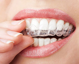 Alternative to Braces for Teens