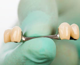 Dental Bridges