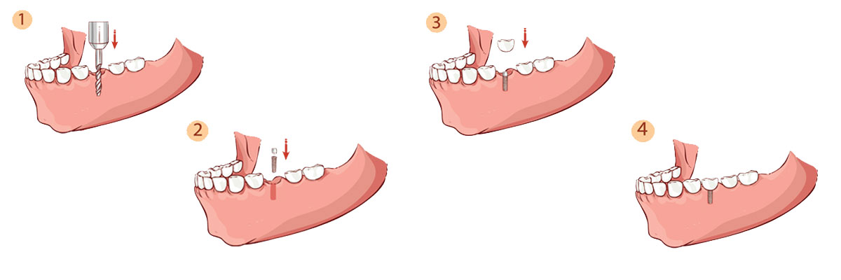 Katy The Dental Implant Procedure