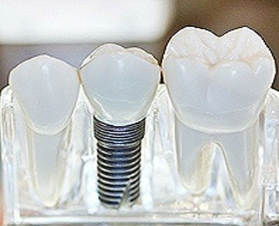Dental Implant Restoration