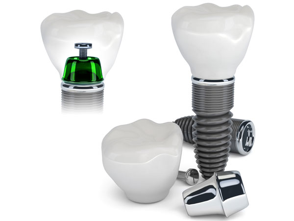 Dental Implant Surgery