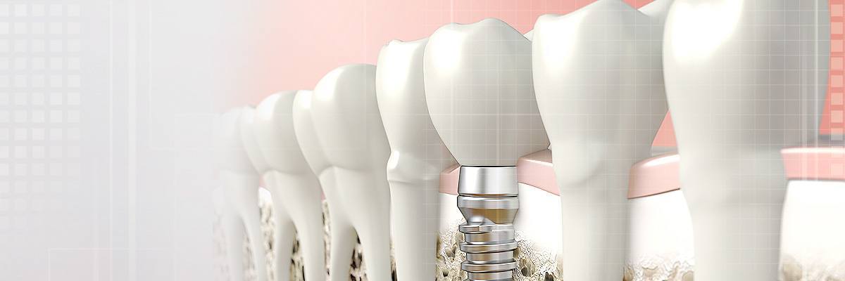 Katy Dental Prosthetics