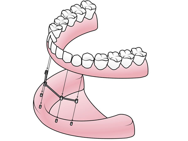 Implant Supported Dentures