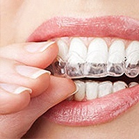 Invisalign Dentist