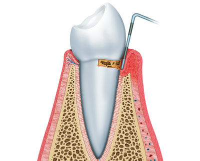 Root Scaling and Planing Katy, TX